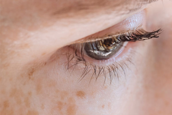 Pigmented Skin