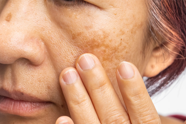Melasma
