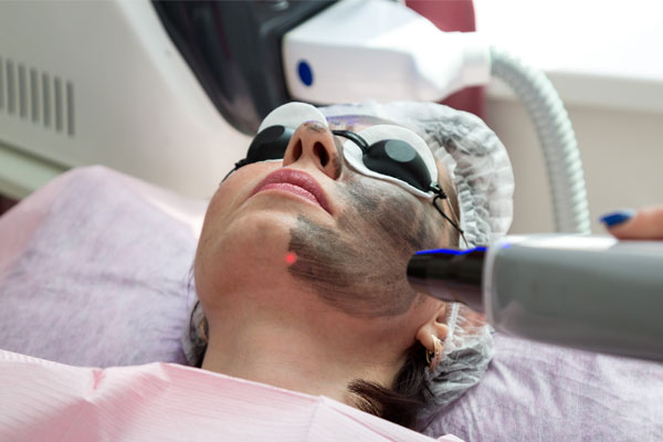 Carbon / Laser facial Peel