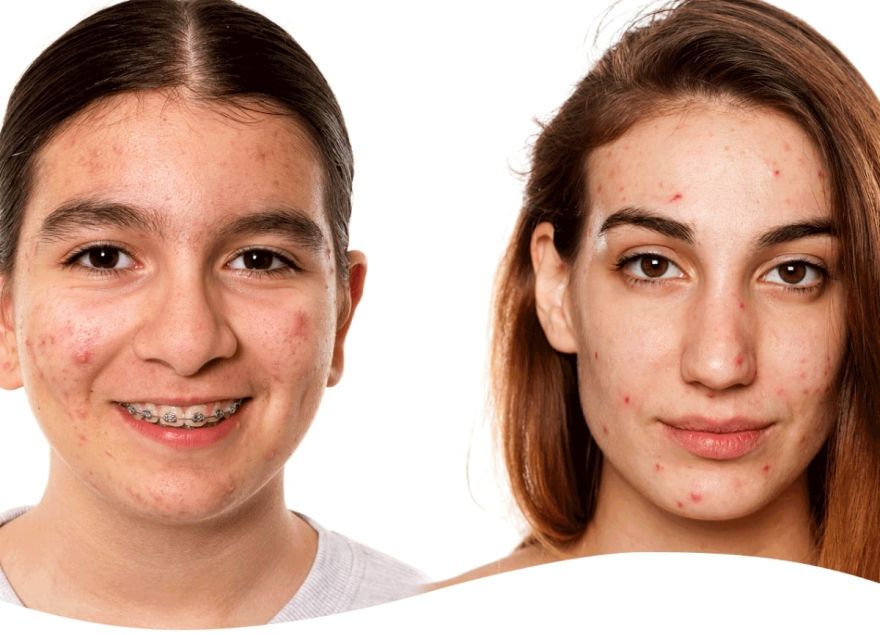 dermapen+new