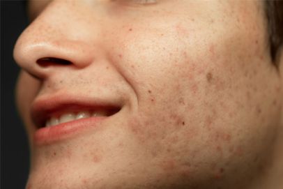 Acne Scars
