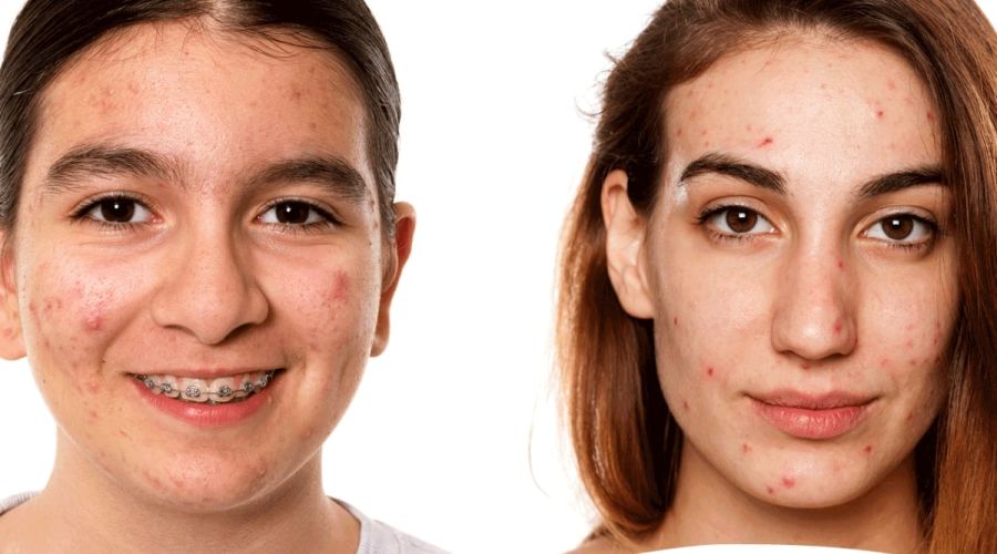 dermapen+new